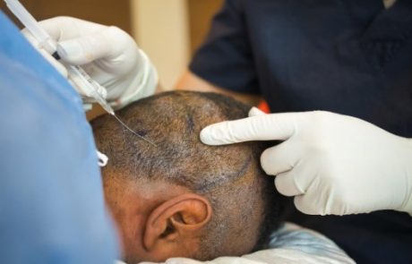 כיצד לבחור השתלת שיער המתאימה לך?